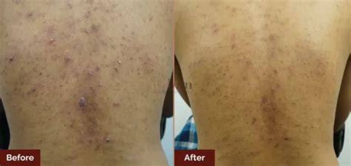 Back Acne Before And After Accutane
