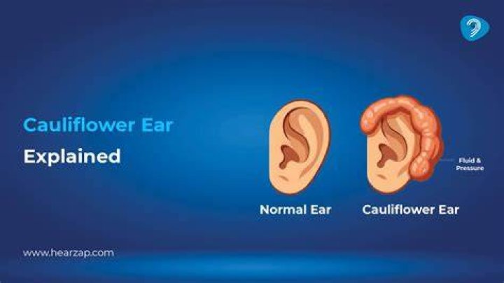 Can You Get Cauliflower Ear From Headphones Everything You Need to