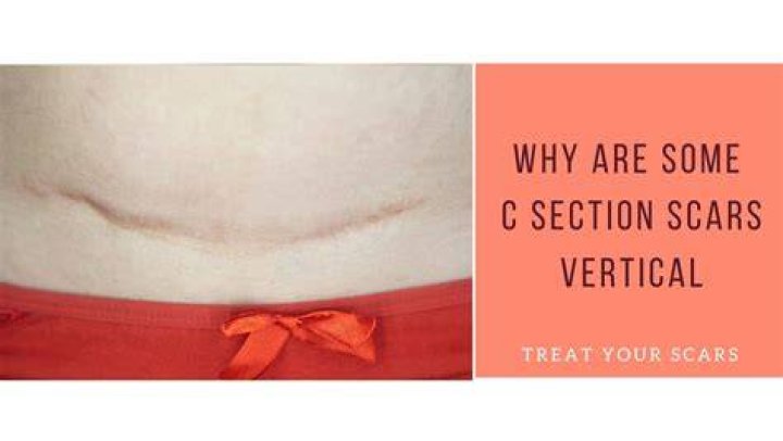 Csection Scar Smells Why It Happens and What To Do