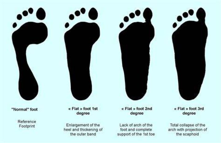 Foot print iin flat feet Foot 'n' Ankle Clinic Kochi Kerala