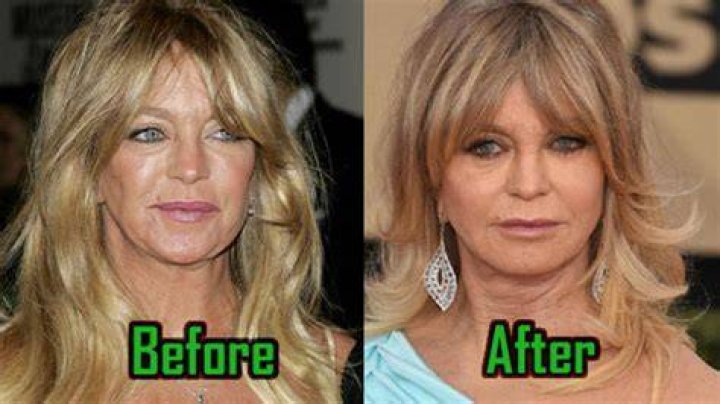 Goldie Hawn Plastic Surgery Before And After Photos