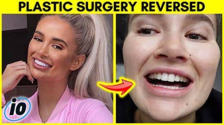 Haley Layne Plastic Surgery Complete Details Before and After Lights