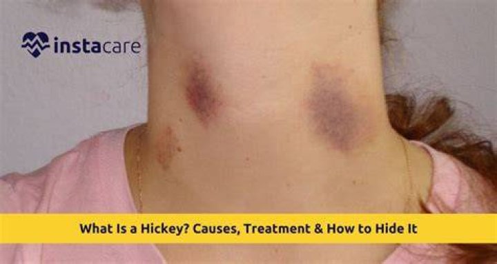 How To Lessen A Hickey Baseballprince20
