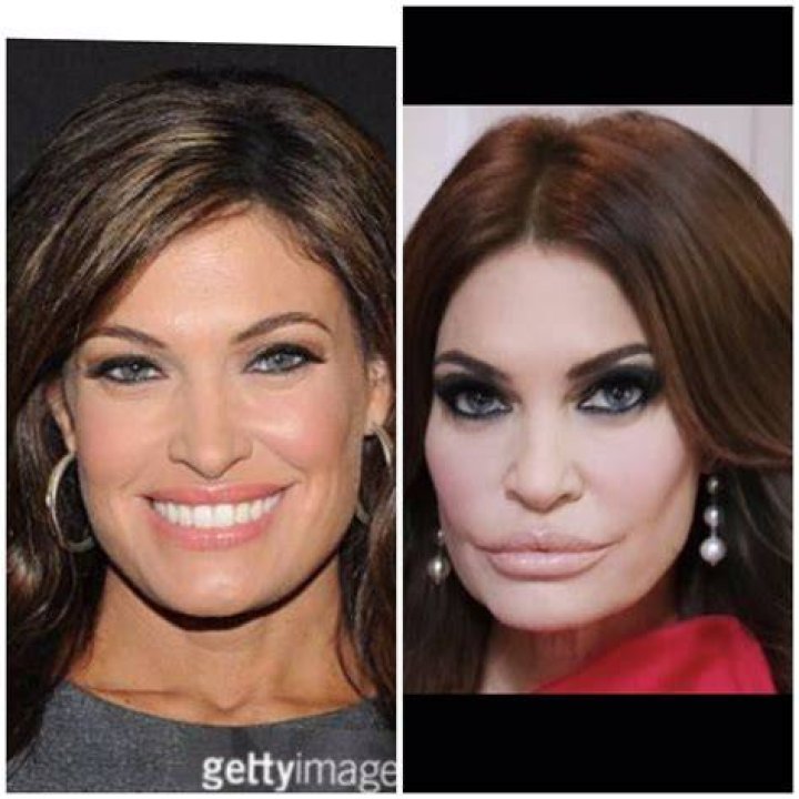 Kimberly Guilfoyle&rsquo;s Plastic Surgery Unraveling Rumors Surrounding Her