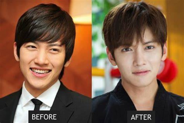 Korean Actors Surgery Before And After
